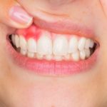 Почему важно никогда не откладывать лечение абсцесса зубов